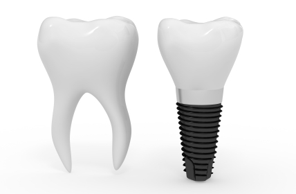 Rendering image of single tooth replacement at United Smile Centres, Louisville, KY