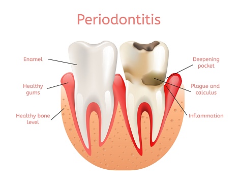 Illustration of periodontitis at United Smile Centres, Louisville, KY.