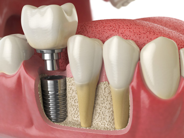 Diagram of dental implant in to jaw bone at United Smile Centres in Louisville, KY
