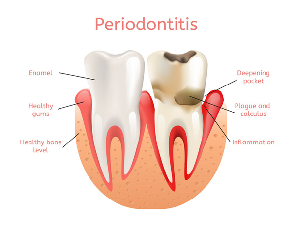 Diagram of a healthy tooth versus a tooth with periodontitis.