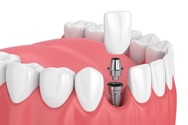 Photo of dental implants from United Smile Centres in Louisville, KY