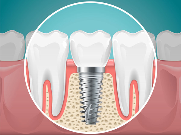 Diagram of a tooth replaced with a dental implant at United Smile Centres in Louisville, KY