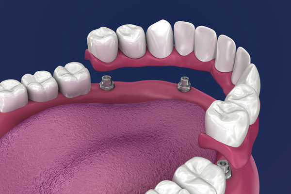 3D rendering of overdentures in a mouth, at Louisville, KY office.