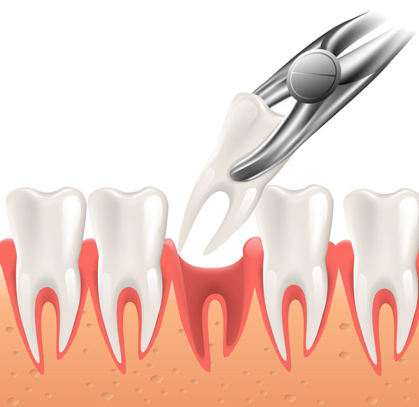 Illustration of a tooth being extracted at United Smile Centres in Louisville, KY