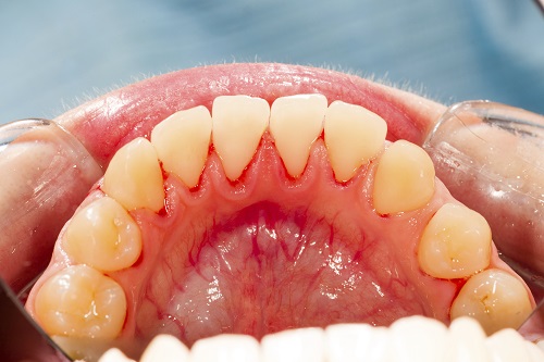 What are the Causes and Treatment of Gum Disease?
