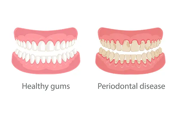 Side-by-side illustration of healthy gums and gums affected by periodontal disease, highlighting gum recession and tooth damage.