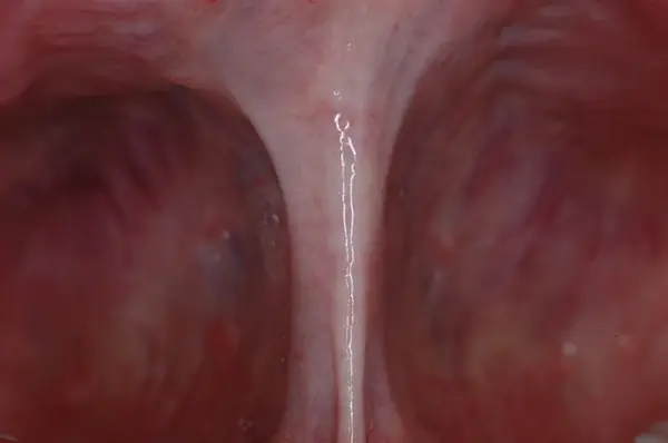 Frenectomy procedure 1
