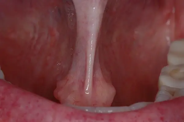 Frenectomy procedure 1