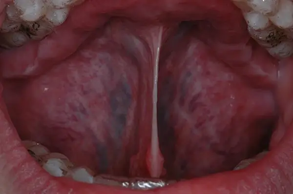 Frenectomy procedure 1